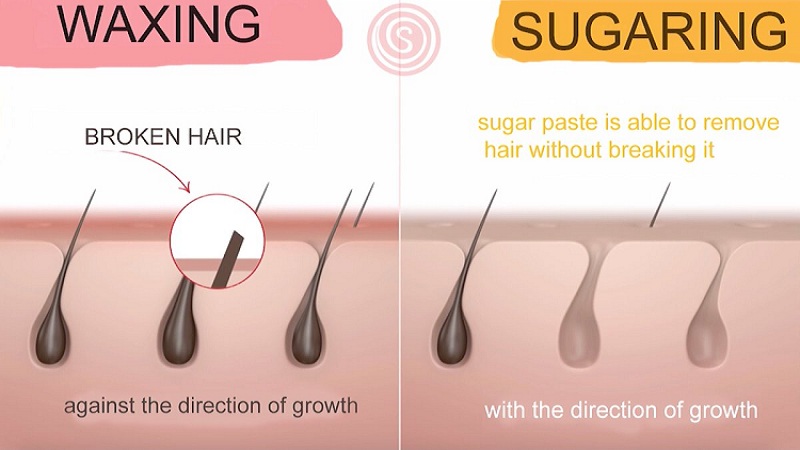 Sugaring vs.  Ingrown hair removal